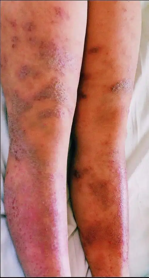 人卫儿科学 2018-10-12_小儿湿疹_发病原因_症状表现_如何预防_检查