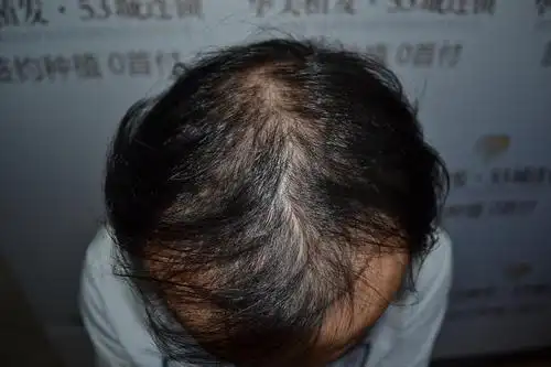 慢性脂溢性脱发怎么治疗?对它你了解多少?