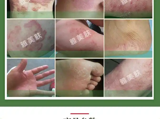 雅美肤苗癣王癣痒灵癣立青藓软膏外用癣立克癣水癣喷剂根净霸手足体股