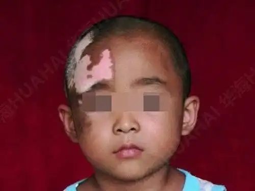 6岁儿童患白癜风被叫"白头怪",获免费救治康复