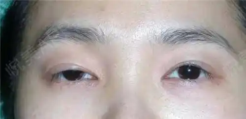 割双眼皮前先看看你是不是上睑肌无力