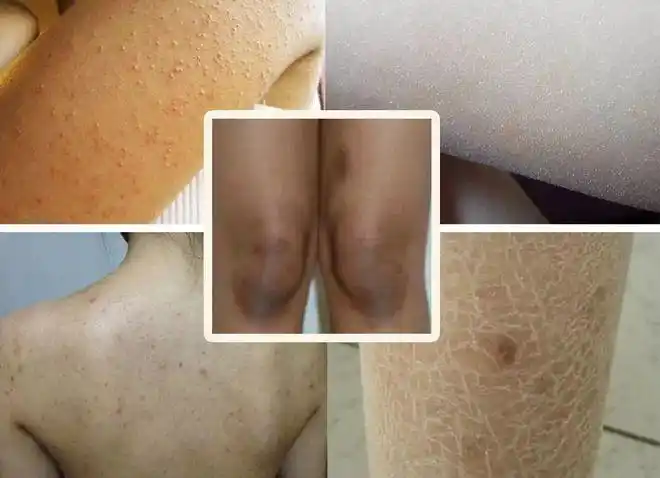 *膝盖,手肘等处又黑又皱; *身体皮肤不再光滑柔嫩,而是干纹明显; *穿