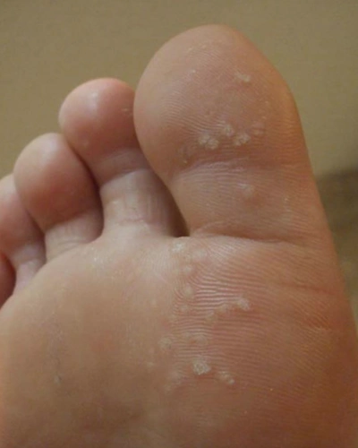 皮肤科医生:疣属接触传染 去公共健身房要小心!