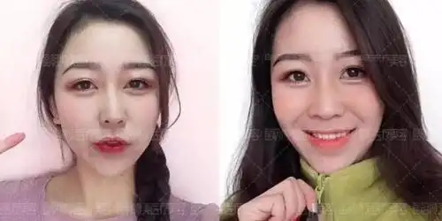 5s重睑术案例对比单眼皮与双眼皮的较量