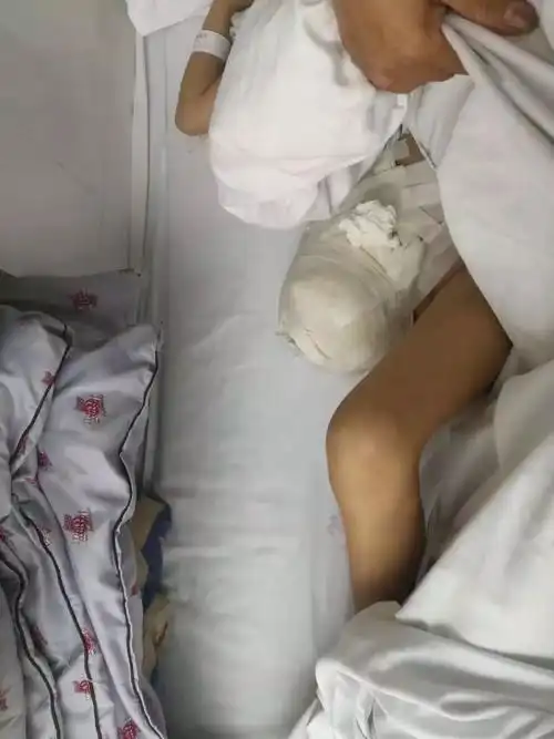 心疼徐医附院的这个女孩还是截肢了就在她过10岁生日的前一天