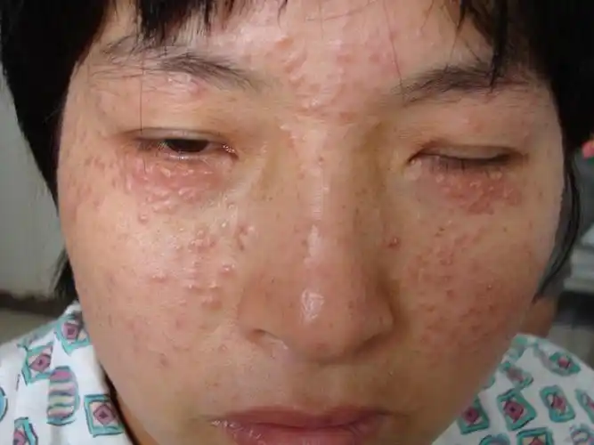 皮肤病颜面播散性粟粒性狼疮