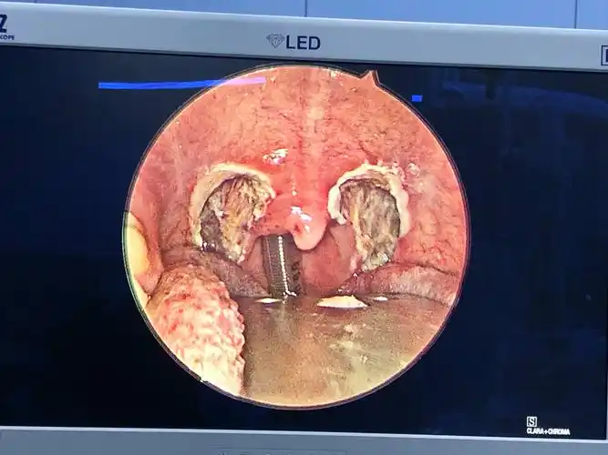 低温等离子射频消融术做鼾症(osahs)手术(改良悬雍垂腭咽成型术)的