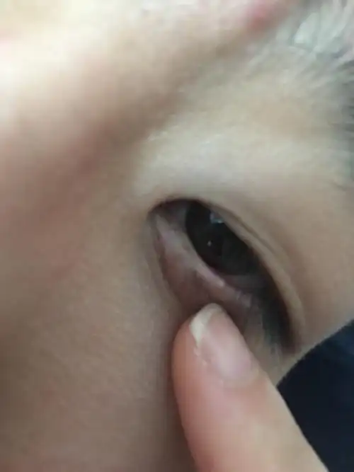 眼睑有个白色小点,不知道是什么