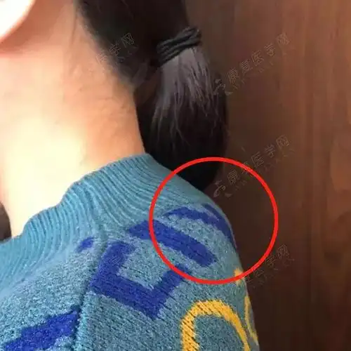 斜方肌紧张颈后大包上交叉综合征造成虎背熊腰的原因都在这了