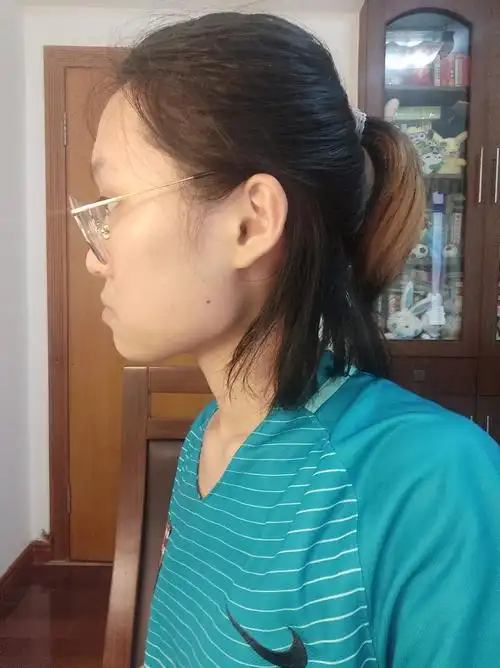 求问这种侧脸是什么问题