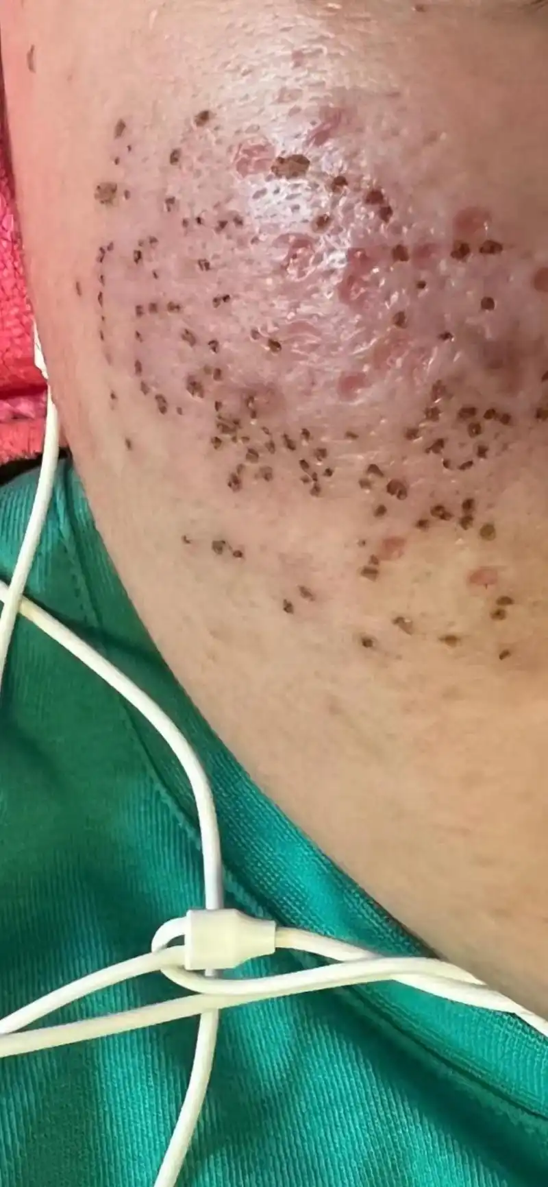 痘痘黑头粉刺拜拜 #问题性皮肤管理 #同城美容护肤 #告别 - 抖音