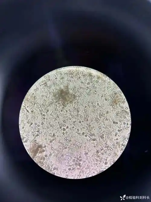 揭秘痛风尿酸钠结晶的出现意味着什么