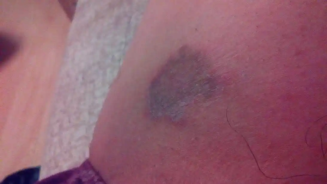 问:大腿内侧不知什么时候开始有点痒,发现成这样子了,而且月挠越有点