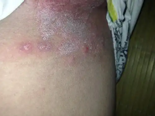 男,大腿内侧,很红有时还很痒,有有白色的皮屑.