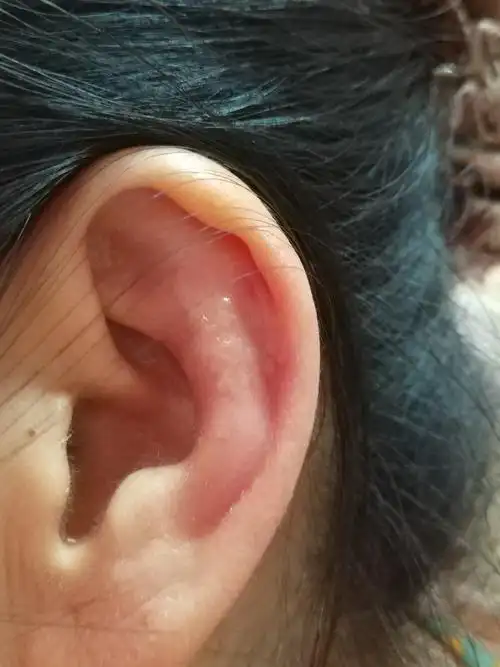 耳廓发热发红几天,今天长小气泡了,是什么原因?