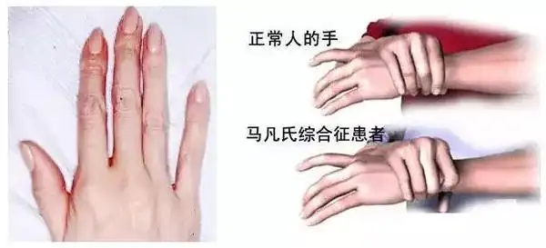 号称"天才病"的马凡氏综合征,究竟是什么?