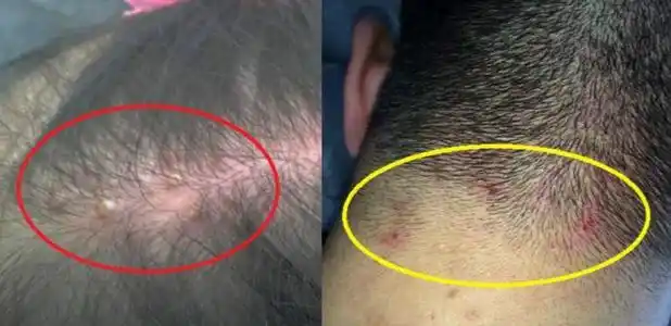 头皮爱长痘痘,跟最常做的1件事有关,可能是毛囊健康的"元凶"