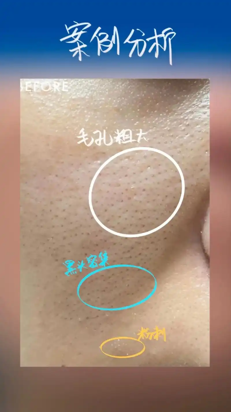 毛孔粗大怎么办?#解决任何皮肤问题 - 抖音