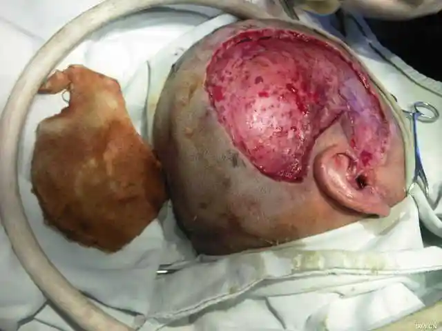 小面积头皮撕脱伤再植, 已长出头发!