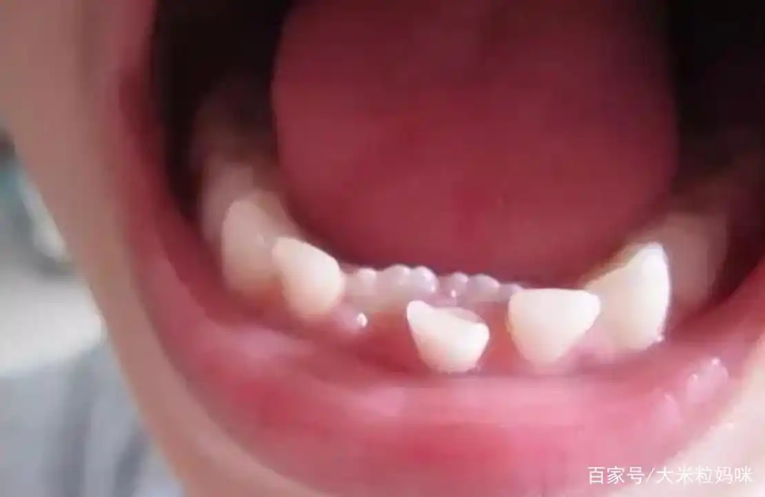 孩子长出"双层牙",只因家长总给孩子吃这种食物,孩子白遭罪