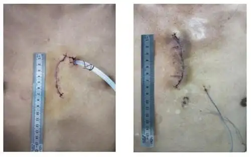 小林(左)和老刘(右)的微创手术切口传统开胸心脏手术切口一般在20cm