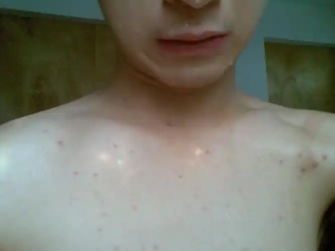 我胸口上一点一点红红的是什么?起码有10几年了