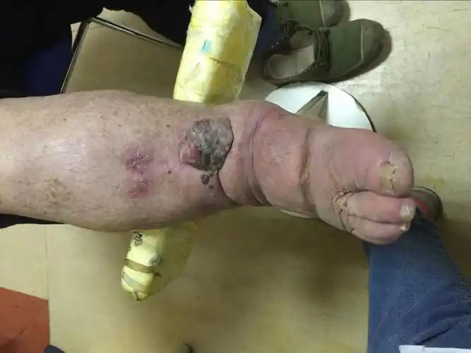 橡皮腿上恶性黑色素瘤的治疗 - 微医(挂号网)