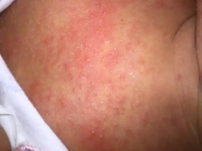 22天胸口和后背长了一片红色的小包,有的还是白头,这是湿疹还是痱子?