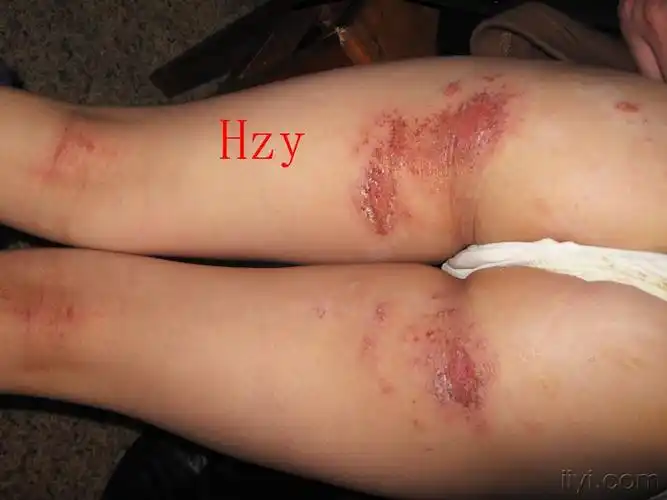 姑娘臀部的皮肤病公布答案湿疹