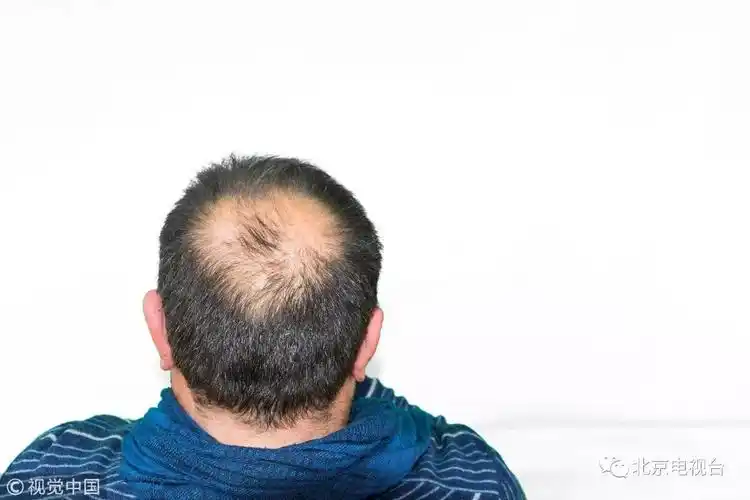 90后成秃头主力这件头等大事再不注意就晚啦