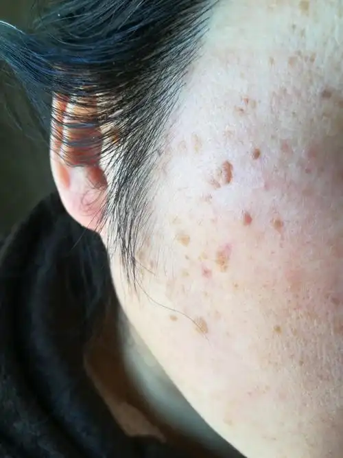 这脸上是什么原因引起的皮肤病