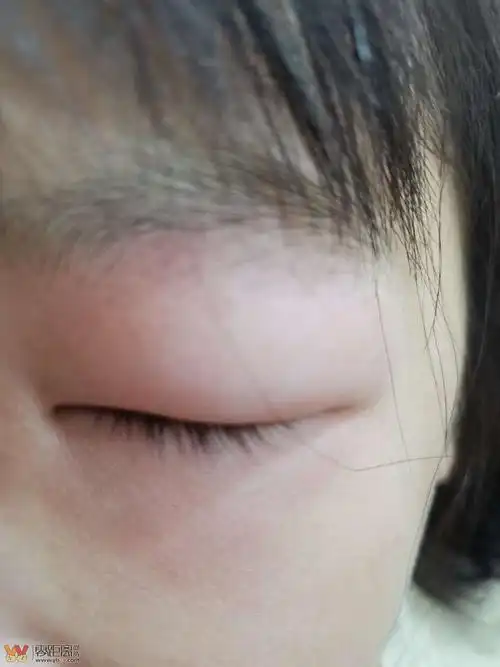 早上起来,眼睛肿成这样,是被夜蚊子亲了吗?