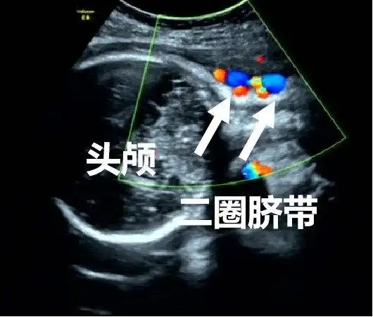 超声在胎儿颈部观察有无脐带回声,彩色血流观察脐带血流情况.