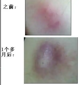 肩膀后面长了一个像粉刺类的小硬包,无粉头,表皮光滑,包有些发紫.