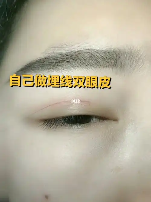 自己做埋线双眼皮 一整天都好看_埋线双眼皮_单眼皮_眼妆_眼皮松弛