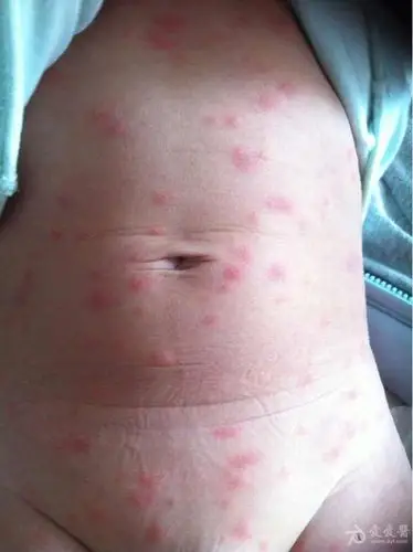 求助大家帮忙看看第二次到底啥疹子呢两次出疹发烧