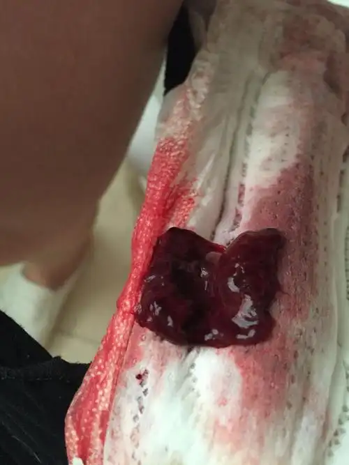 前天晚上开始肚子疼有点黑红色的血直到昨天晚上开始