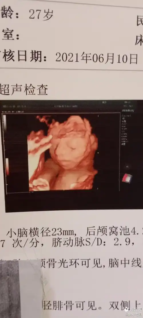 四维彩超的照片,准确率还是挺好高的,生下来基本一样,很秀起的小公主