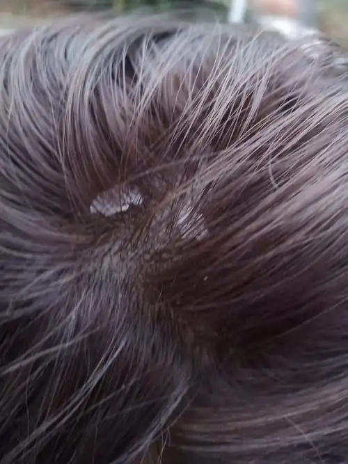 见过的最大头皮屑多大? - 知乎