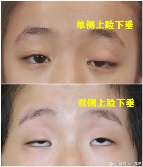 重症肌无力上睑下垂如何治疗?检查,诊断,制定方案,术后护理