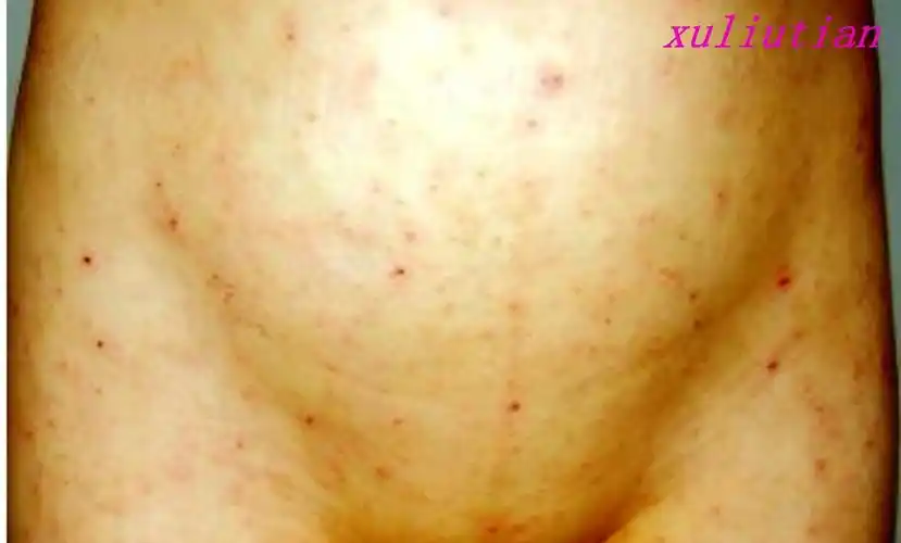 16疥疮图片之二:疥疮图片之一:四,得了疥疮都有哪些症状?