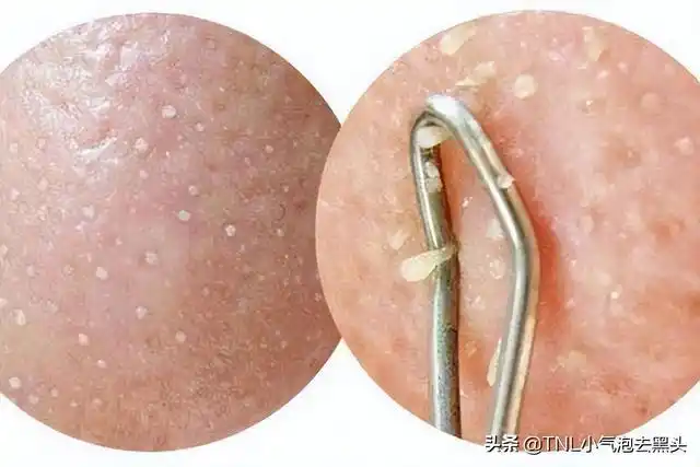 龟头上起白色脂肪粒