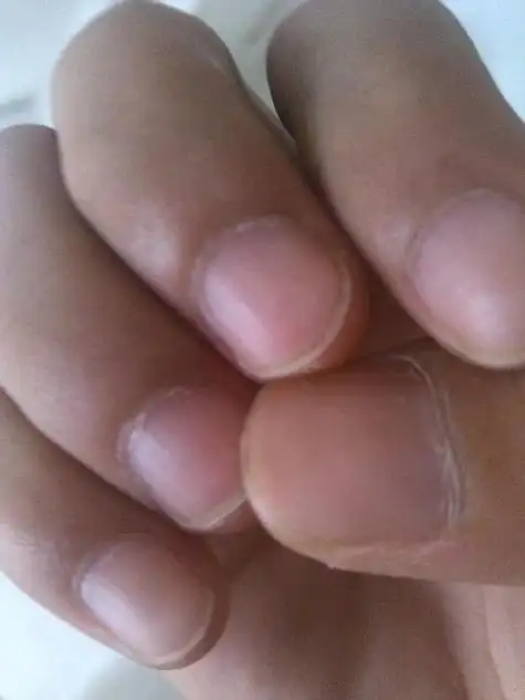 心脏病的手指甲,心脏不好的人指甲是什么样子的?-图片大观-奇异网
