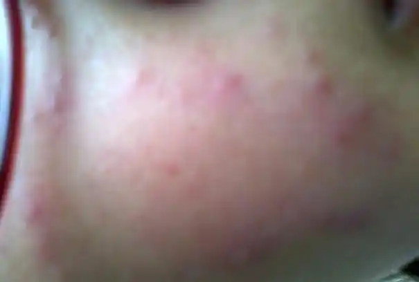 脸上皮肤过敏症状(图片) - 茚象泉皮肤过敏专家 - 脸上过敏怎么办