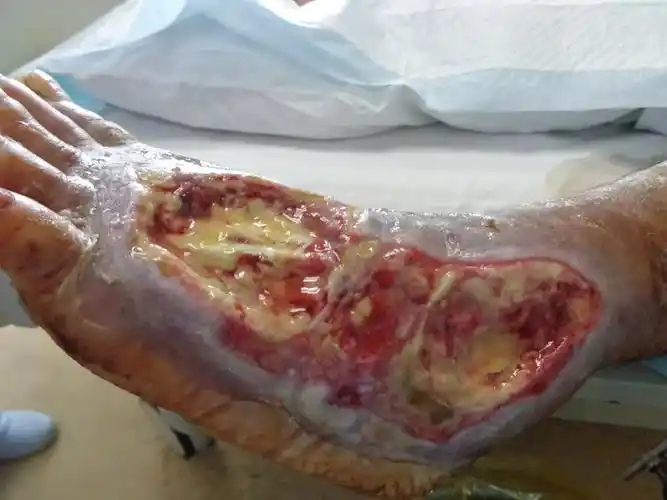 皮肤溃疡愈合助力器——vsd术_创面