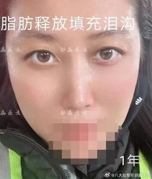 【去眼袋填脂肪术后一年反馈】内切眼袋 眶隔脂肪释放填充泪沟,这是求