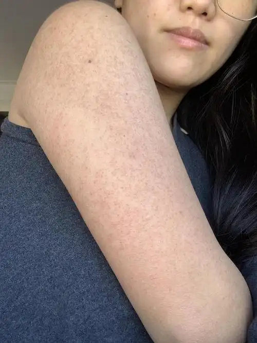 第四天,昨天晚上太痒了就洗了个澡,感觉皮肤更干燥了,但是还没有脱皮.