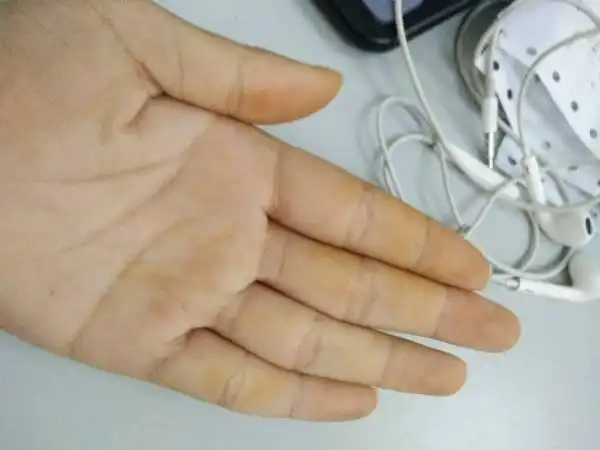 手突然变黄怎么回事?求解答