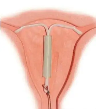 上环是什么意思:上环的基本知识及注意事项