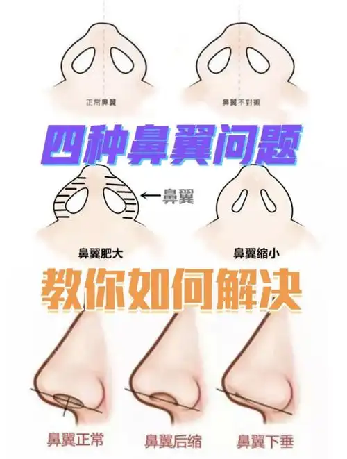 武汉美基元四种鼻翼问题教你如何解决
